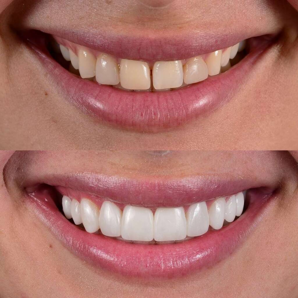 معرفی انواع لمینت و کامپیوزیت دندان - دندونیا | فروشگاه تخصصی تجهیزات و مواد دندانپزشکی 🦷 معرفی انواع لمینت و کامپیوزیت دندان