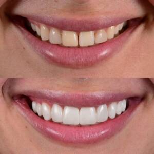 معرفی انواع لمینت و کامپیوزیت دندان