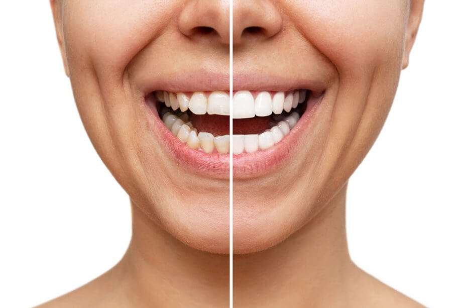 معرفی انواع لمینت و کامپیوزیت دندان - دندونیا | فروشگاه تخصصی تجهیزات و مواد دندانپزشکی 🦷 انواع لمینت دندان و کامپوزیت دندان