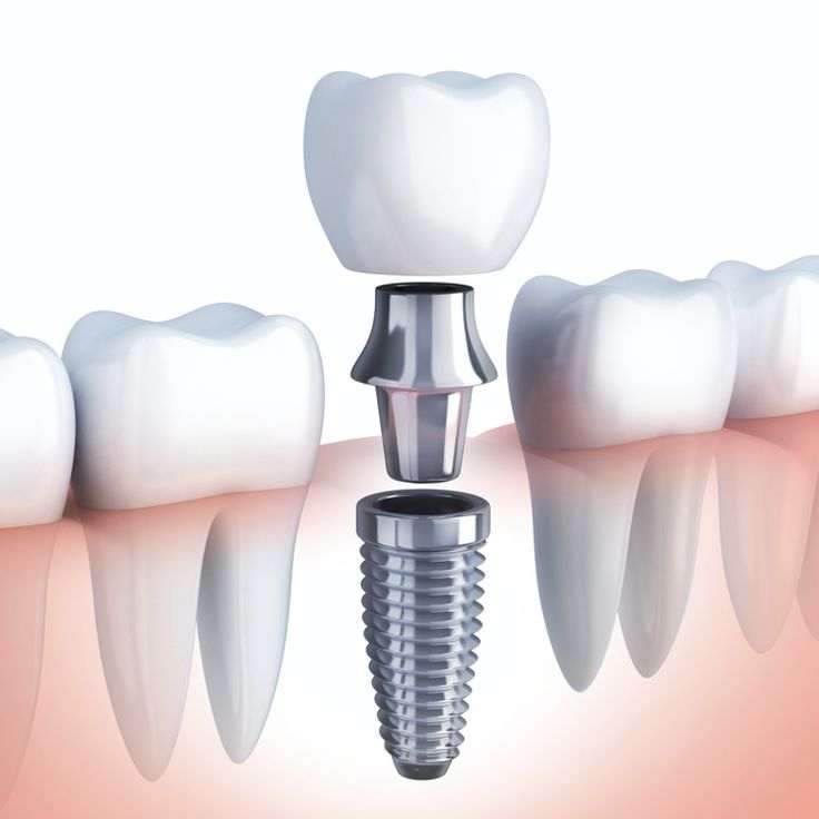 ایمپلنت دندان چیست؟ - دندونیا | فروشگاه تخصصی تجهیزات و مواد دندانپزشکی 🦷 ایمپلنت دندان چیست؟