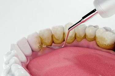 بلیچینگ دندان یا جرمگیری دندان؟ کدام روش برای شما مناسبتر است؟ | دندونیا | فروشگاه تخصصی تجهیزات و مواد دندانپزشکی 🦷 عوارض رایج جرمگیری دندان