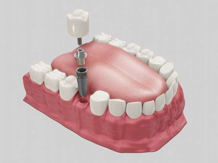 ایمپلنت دندان چیست؟ - دندونیا | فروشگاه تخصصی تجهیزات و مواد دندانپزشکی 🦷 مراحل کلی ایمپلنت دندان