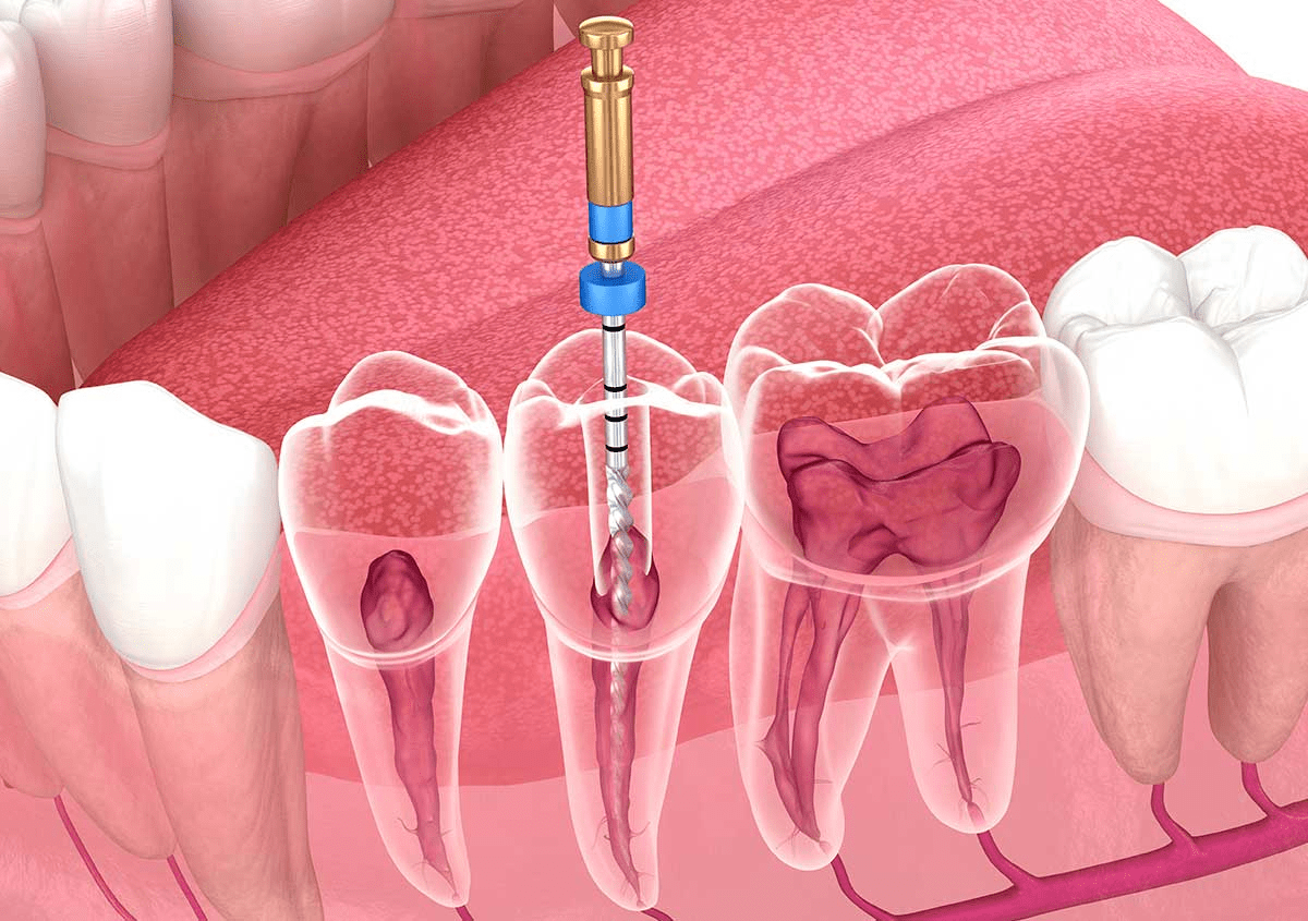 آشنایی با ابزارهای مدرن عصب کشی دندان | دندونیا | فروشگاه تخصصی تجهیزات و مواد دندانپزشکی 🦷 عصب کشی چیست؟