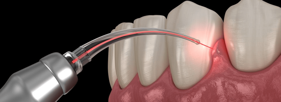 راهنمای کامل کاربرد لیزر در دندانپزشکی | دندونیا | فروشگاه تخصصی تجهیزات و مواد دندانپزشکی 🦷 لیزر بافت نرم
