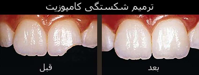 راه های مراقبت و ترمیم کامپوزیت دندان - دندونیا | فروشگاه تخصصی تجهیزات و مواد دندانپزشکی 🦷 ترمیم کامپوزیت دندان