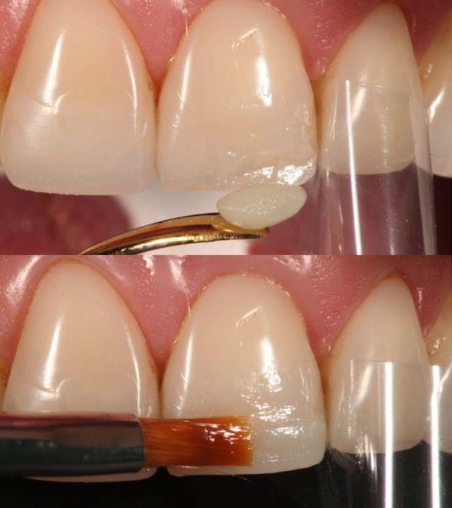 راه های مراقبت و ترمیم کامپوزیت دندان - دندونیا | فروشگاه تخصصی تجهیزات و مواد دندانپزشکی 🦷 ترمیم کامپوزیت