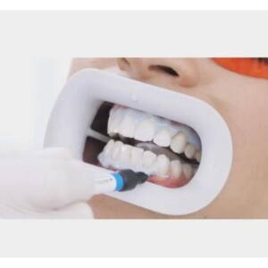 Alternative view of دهان‌ بازکن فلش‌ لیپ WHITESMILE Flash Lip Retractor